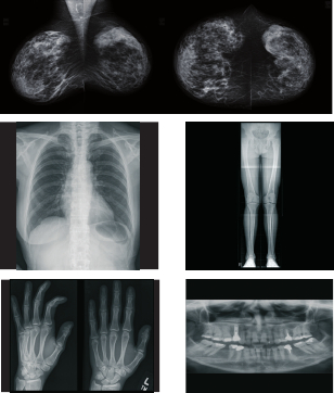 Рентгеновские снимки, сделанные с помощью АГФА CR 30-Xm