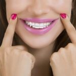 У девушки стоят брекеты из клиники DDclinic